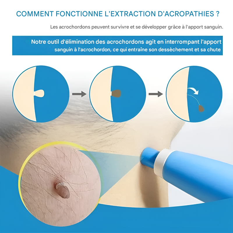 Fibroom Verwijderingskit - Eenvoudige Cryotherapie